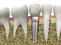 Dental implants - Ryan Senft DDS Dentistry in Cupertino, CA