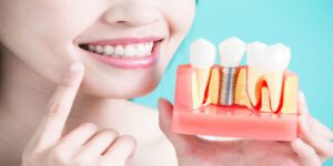 The 5 Benefits of Dental Implants