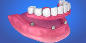 Traditional vs Implant Supported Dentures