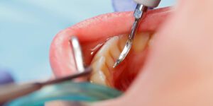 Understanding Dental Scaling and Root Planing