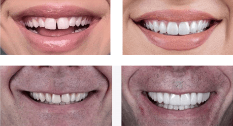 teeth of two patients before and after Same-Day Crowns treatment