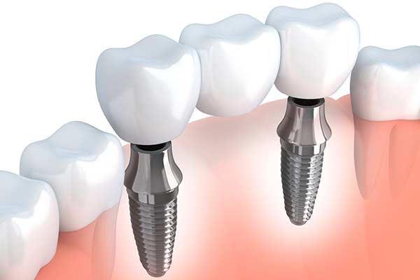 Dental Implant Supported Bridges

