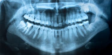 Wisdom teeth button2